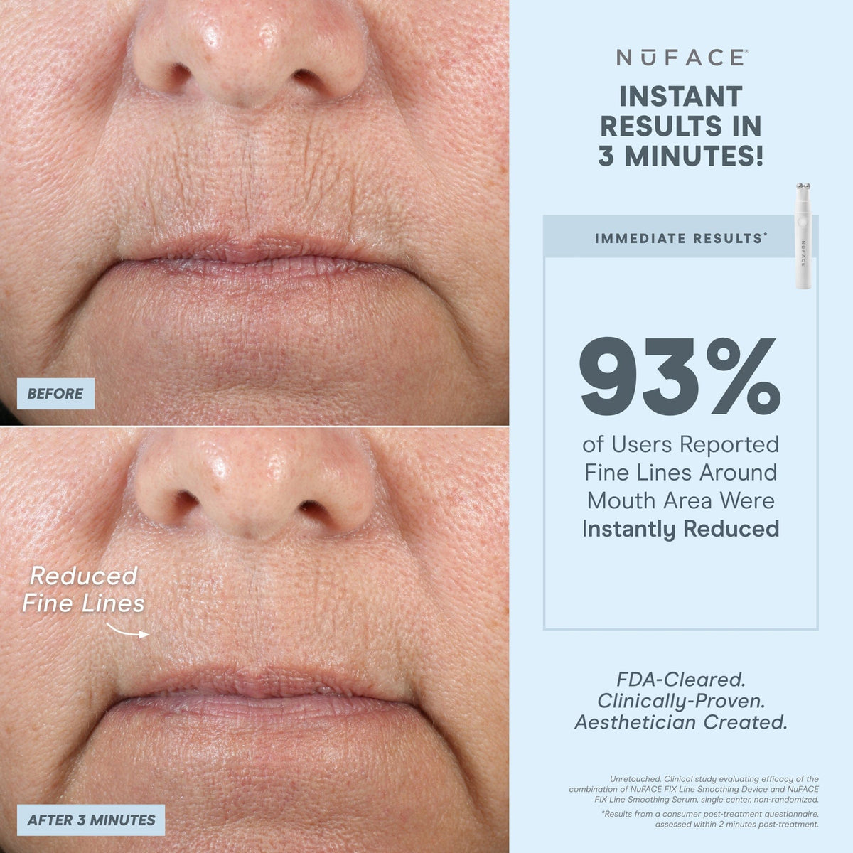 NuFACE FIX® Line Smoothing Device - Microcurrent Device