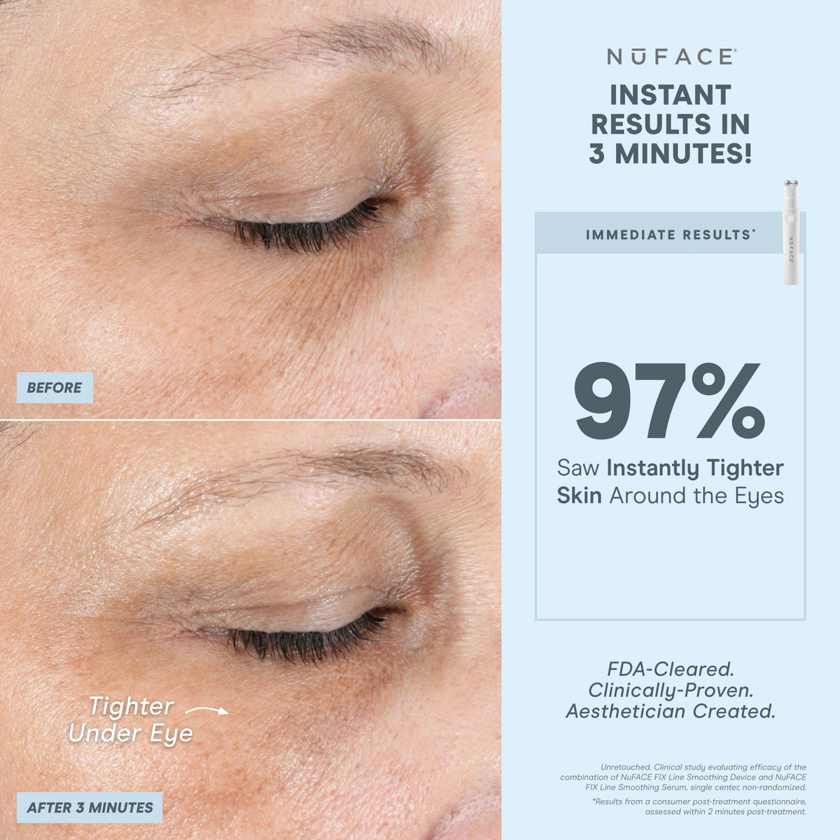 NuFACE FIX® Line Smoothing Device - Microcurrent Device